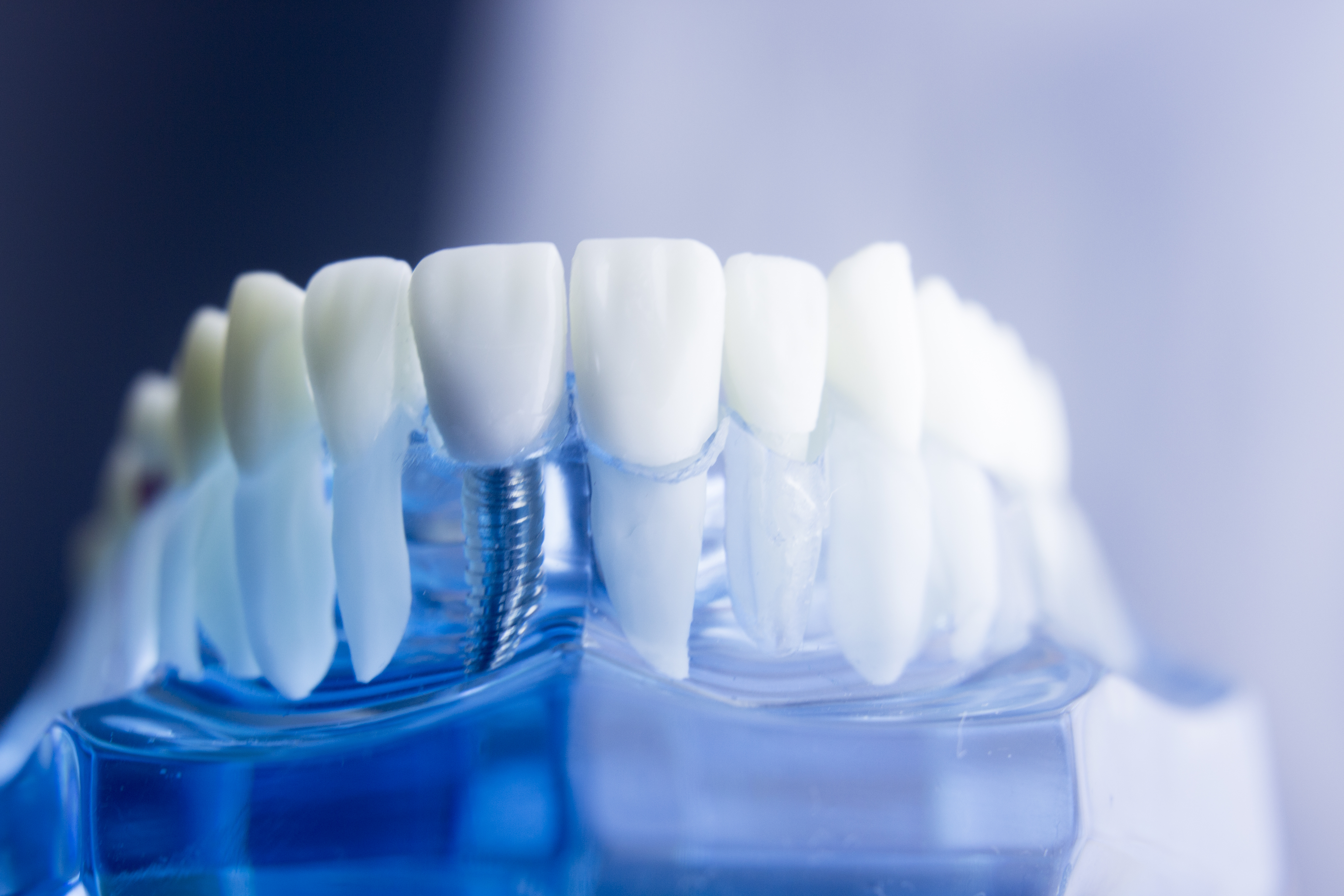 インプラント治療